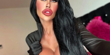 Percebeu a diferença? Barbie Humana reduz preenchimento labial; veja fotos